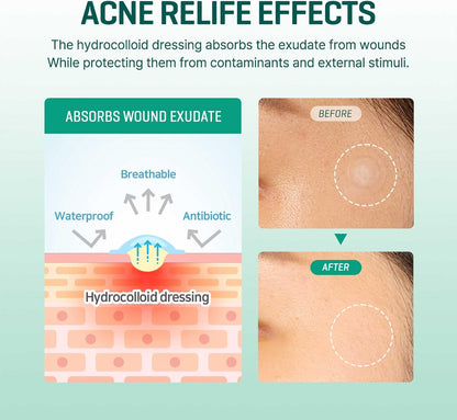 SOME BY MI – 30 Days Miracle Clear Spot Patch (18 patches)